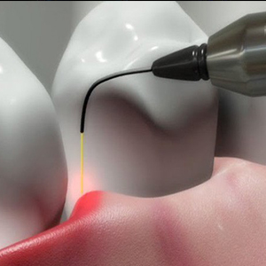 کاربرد های لیزر در درمان‌های دندان‌پزشکی