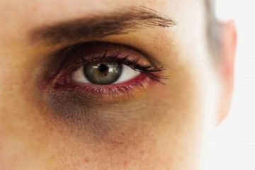 ازبین بردن تیرگی دور چشم‌های با این روش